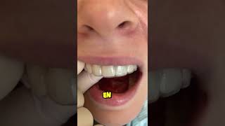 un implante dental es mejor que un diente natural dientes dentista tips parati viral fyp [upl. by Galang]