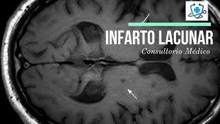 Infarto Lacunar Causas Síntomas y Tratamiento 👨‍⚕️ Consultorio Médico [upl. by Nereil]