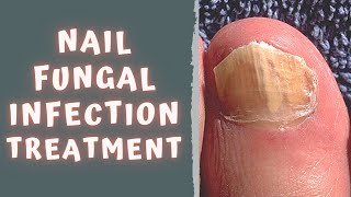 HOW TO TREAT FUNGAL NAIL INFECTION  TINEA UNGUIUM  ONYCHOMYCOSIS [upl. by Robinet807]