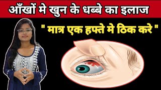 Sub Cunjuctiva Hemorrhage Treatment  Ankho Me khun ke Lal Dhabbe Ka Ilaz  In Hindi [upl. by Nohsram]