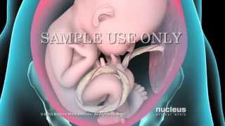 Breech Birth Position  3D Rotation [upl. by Leahicm]