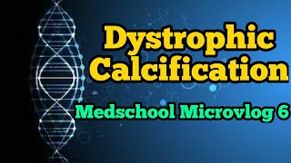 Dystrophic calcificationPathologic calcificationMedschool Microvlog 6 [upl. by Eelnayr]