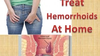 How To Treat HEMORRHOIDS At Home Quickly amp Naturally Without Surgery [upl. by Cloots]