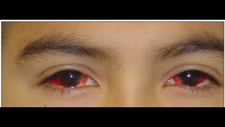 Pediatric Ophthalmology Lecture Preview [upl. by Eitnom]