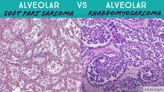 Alveolar Soft Part Sarcoma vs Alveolar Rhabdomyosarcoma [upl. by Harobed]