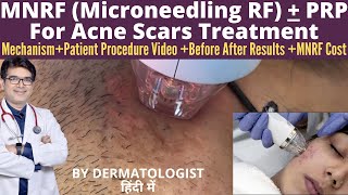 Microneedling RF MNRF Treatment For Acne Scars  MNRF Skin Treatment with PRP  Before After Results [upl. by Earised]