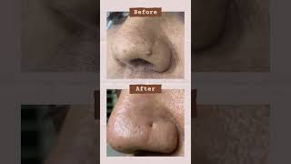 Dermatologist In Thane  Skin Tag Removal Treatment  Dr Pranjal Mittal [upl. by Eldreda165]