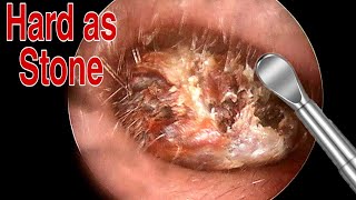 BIGGEST Ear Wax Difficult Removal  EP2  Doctor Anh [upl. by Falito]