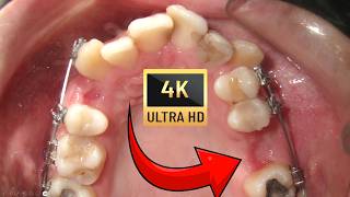 Ectopic canines in ADULTS and WISDOM tooth eruption [upl. by Suzanne]