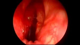 Tuberculose laryngée par endoscopie [upl. by Schilt431]