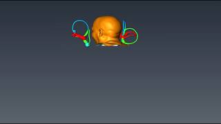 Dix Hallpike to Head Hanging in Left Posterior Canalithiasis Teixido HD [upl. by Dopp]