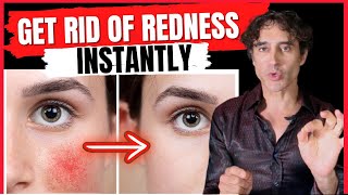 HOW TO GET RID OF REDNESS AND BLOOD VESSELS ON THE FACE [upl. by Hyman]