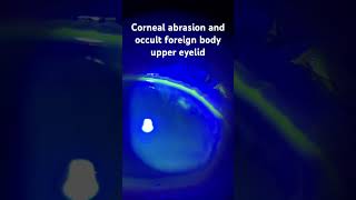 Corneal abrasion and occult foreign body under the upper eyelid protectingsight ophthalmology [upl. by Pansie]