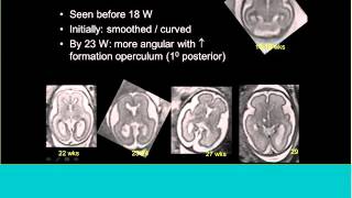 Topics in Fetal Medicine  Gilbert Vezina MD FACR [upl. by Enitnatsnoc291]