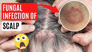 What causes Scalp Ringworm ✅ Effective Treatment Tinea Capitis [upl. by Retlaw]