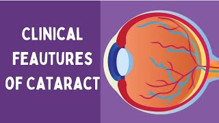 Clinical feautures of Cataract  Ophthalmology  NEETPG [upl. by Moulton438]