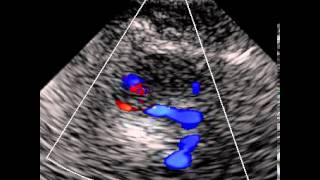 INTRACRANIAL VERTEBRAL ARTERY STENOSIS [upl. by Ardenia]