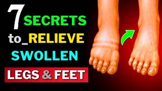 Get Rid of Swollen Legs amp Feet 7 Natural Remedies You Must Try [upl. by Ailekahs769]