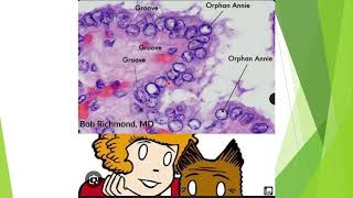 Papillary carcinoma of Thyroid High Yield USMLE topic [upl. by Choo]