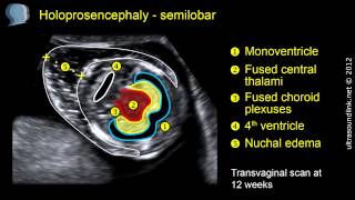 Semilobar holoprosencephaly 2D and 3D ultrasound [upl. by Einahpehs282]