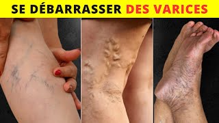 10 Façons Naturelles pour se Débarrasser des Varices et Augmenter le Flux Sanguin [upl. by Steinberg559]