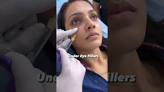 under eye filler treatment helps you get rid of wrinkles  Dermalyn Aesthetics  Dr Muskan Tyagi [upl. by Holden]