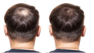 6 Foods That Can Block DHT and Fight Hair Loss [upl. by Weissmann581]