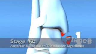 Lauge Hansen PAB Pronation ABduction Eversion Ankle Fracture [upl. by Hallie]