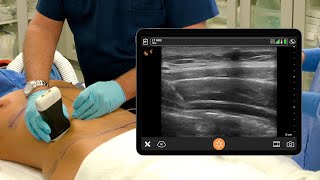 Ultrasound guided Quadratus Lumborum Block QLB1 [upl. by Bradway]