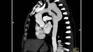 4D Imaging of the Aortic Valve Repaired coarctation of the aorta 1 of 3 [upl. by Lach]