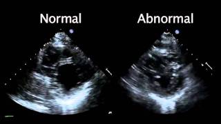 Echocardiogram from the Patient Compared with That from a Normal Control  NEJM [upl. by Howlend]