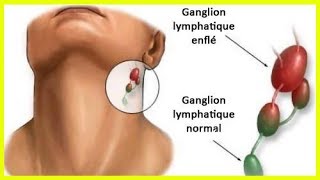 L’inflammation des ganglions lymphatiques  quelle en est la cause [upl. by Rim693]