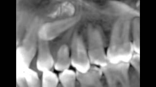 Canines incluses CBCT scan impacted cuspids orthodontie 123213 IT31 [upl. by Clancy]