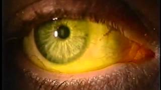 Instilling Fluorescein Dye in the Eye [upl. by Adnilre]