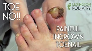 TOE NO Painful Ingrown Toenail Removal [upl. by Yesnyl]