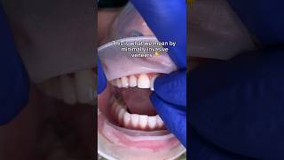 What are minimally invasive veneers 👆🦷 veneers minimalprep porcelainveneers noninvasive [upl. by Balac]