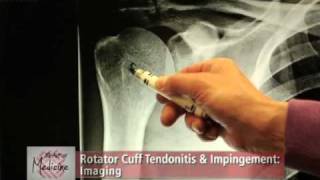 Rotator Cuff Impingement amp Tendonitis Part 2 Symptoms amp Evaluation [upl. by Dolf]