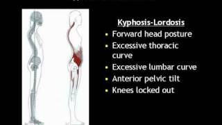 What is Kyphosis Lordosis [upl. by Ettenuahs551]