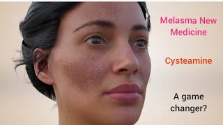 Melasma New Medicine  Cysteamine  Is it a game changer melasma melasmacream melasmatreatment [upl. by Airolg941]