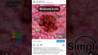 Melanoma in situ [upl. by Aerdnod]