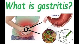 What is gastritis Causes and symptoms of gastritis [upl. by Beverlie]