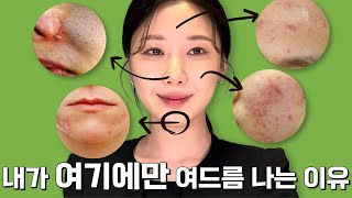 다 이유가 있다 부위별 여드름 없애는 방법🆘 [upl. by Prud]