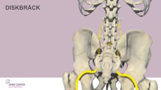 Diskbråck Spine Center Göteborg [upl. by Aurelius]