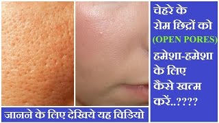 चेहरे के रोम छिद्र को हमेशा हमेशा के लिए खत्म करें  Home Remedy for Open Pores [upl. by Anuahc]