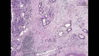 Histopathology Pancreas Adenocarcinoma [upl. by Aeila]