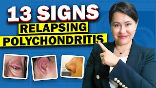 13 Top Signs of Relapsing Polychondritis [upl. by Hiasi736]