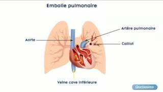 Zoom sur les maladies thromboemboliques veineuses [upl. by Gyasi590]