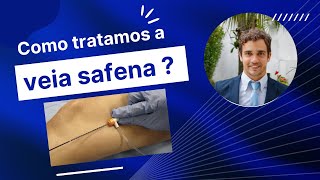 Como fazemos o tratamento da veia safena por ablação radiofrequência  Laser [upl. by Ater]