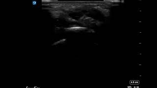 Wrist Ultrasound Arthrocentesis in Short Axis [upl. by Azriel918]