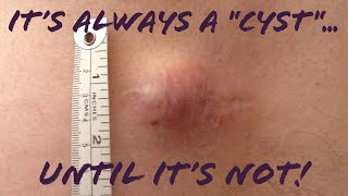 Skin lumpbump Its NOT always quotjust a cystlipomaquot Misdiagnosed Skin CancerSarcoma Mimic Cyst [upl. by Nedrud]